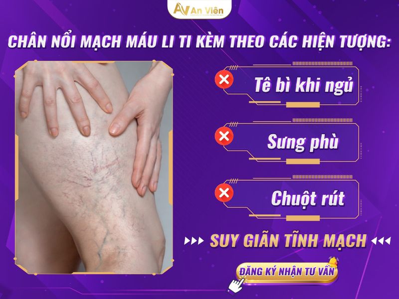 chân bị nổi mạch máu