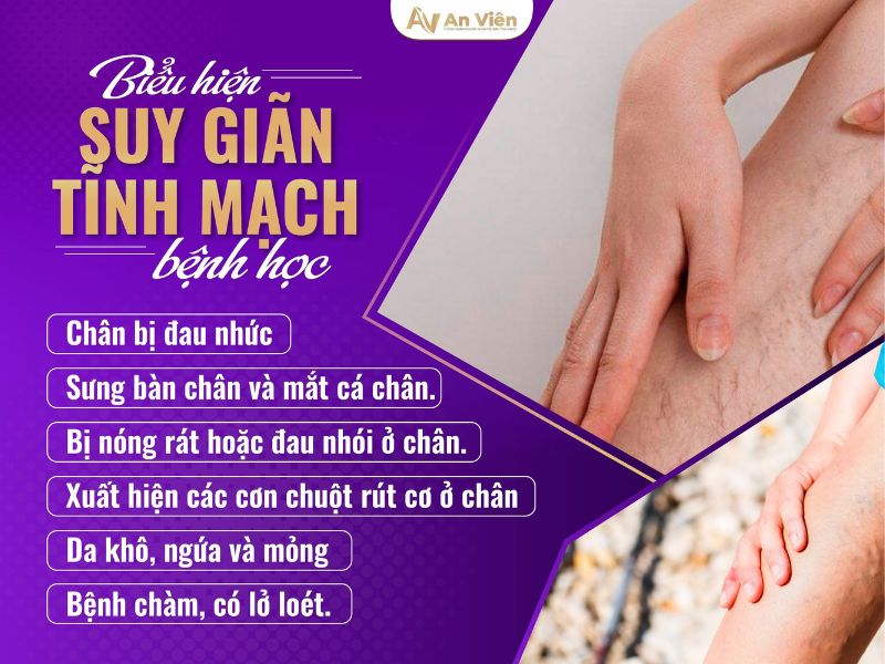 chữa giãn tĩnh mạch chân