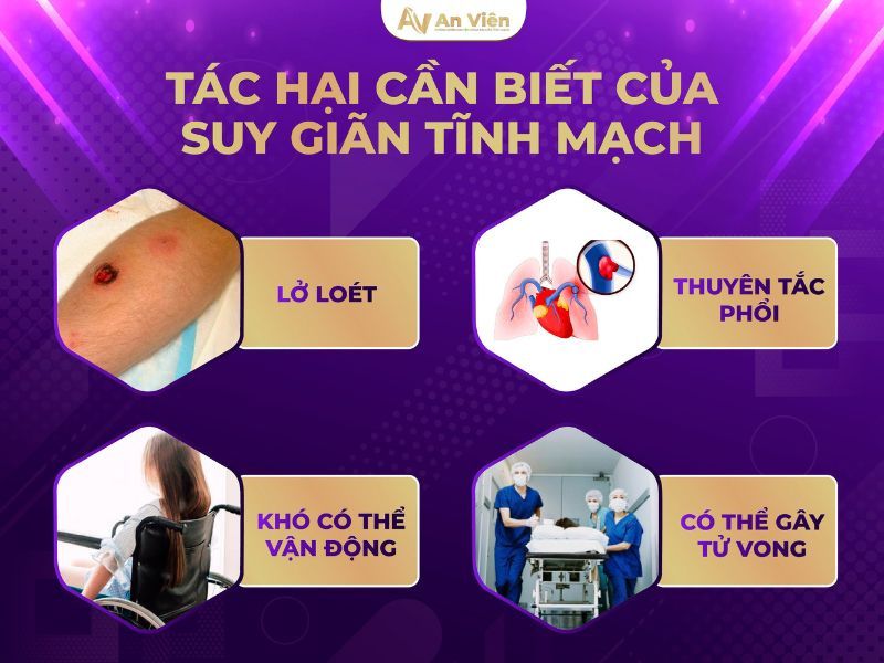 chữa giãn tĩnh mạch chân