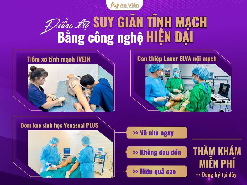 chữa giãn tĩnh mạch chân