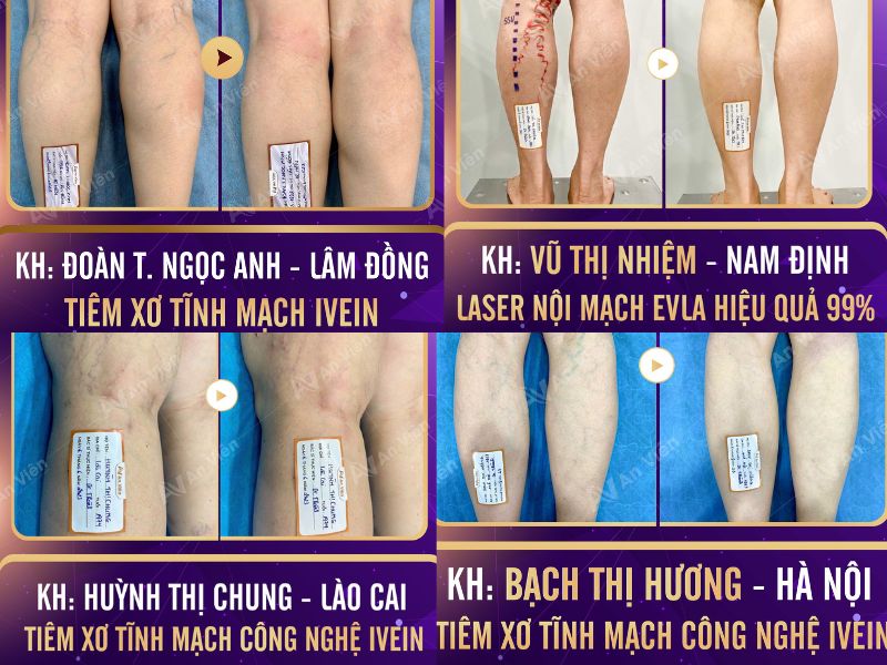 chữa giãn tĩnh mạch chân