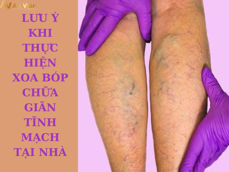 chữa giãn tĩnh mạch tại nhà