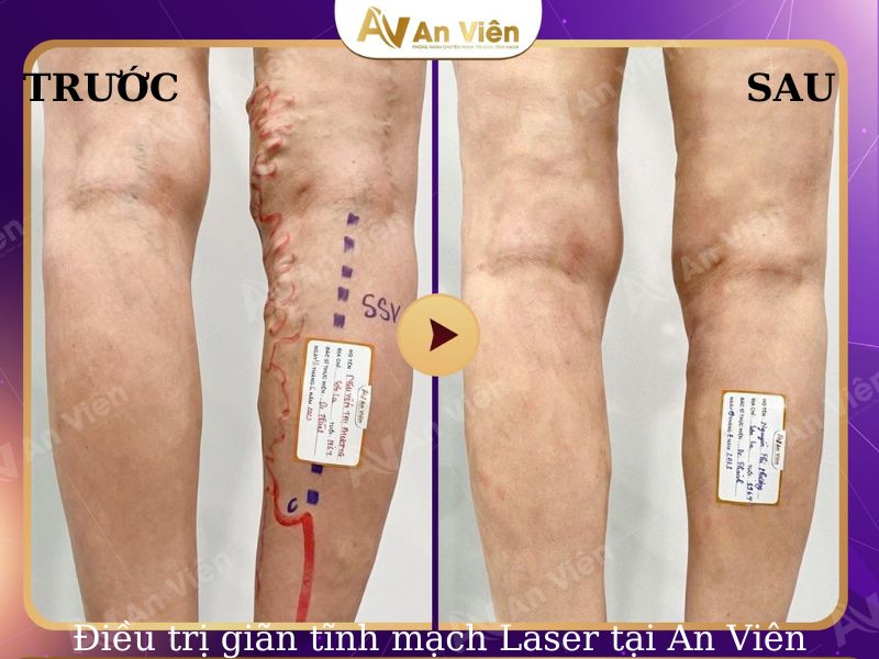 điều trị giãn tĩnh mạch chân
