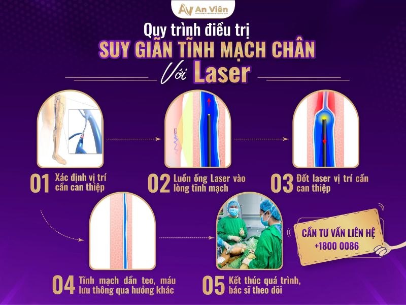 điều trị giãn tĩnh mạch chân
