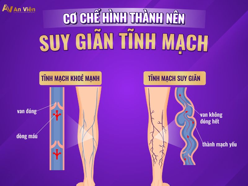 điều trị tĩnh mạch chân