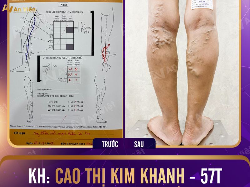 điều trị tĩnh mạch chân