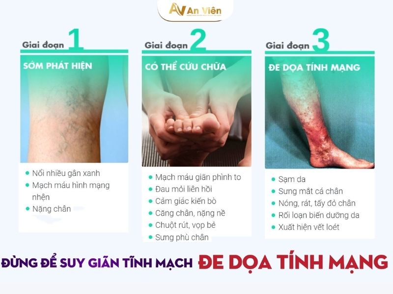 điều trị tĩnh mạch chân