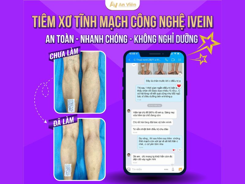 điều trị tĩnh mạch ở chân