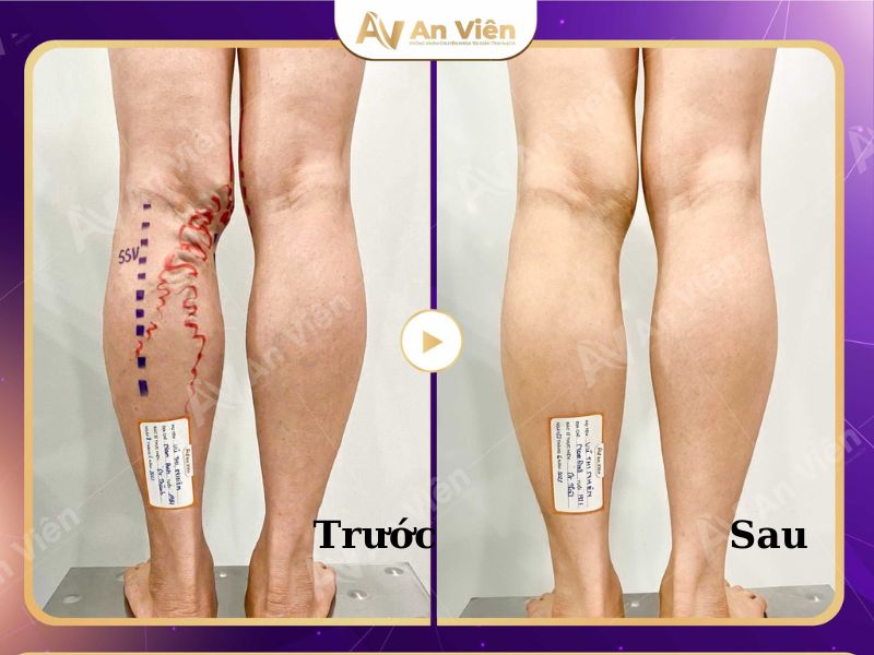 điều trị tĩnh mạch ở chân