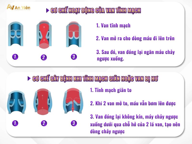 giãn tĩnh mạch chân có chữa được không