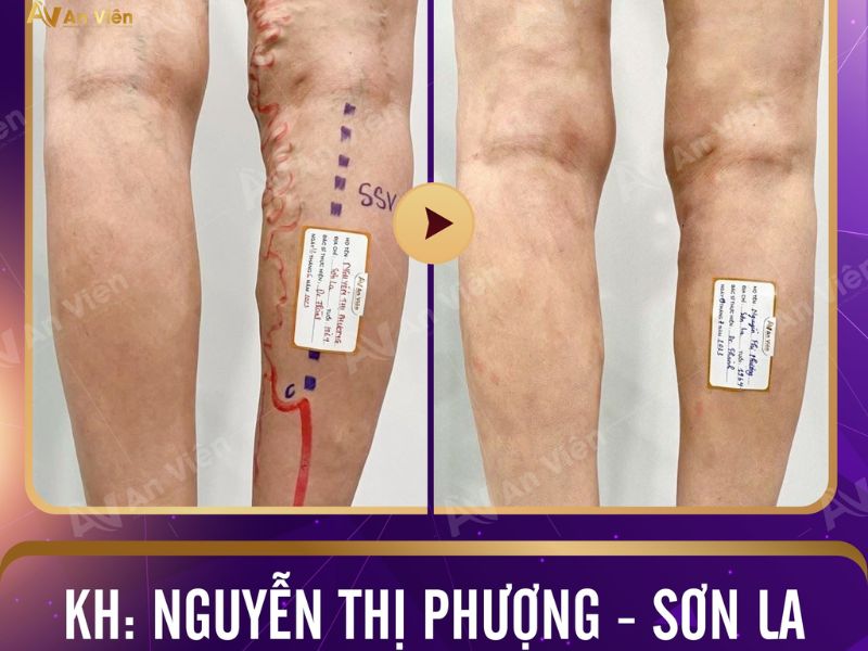 giãn tĩnh mạch chân có chữa được không