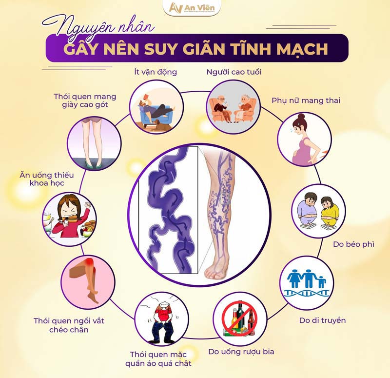 giãn tĩnh mạch chi dưới