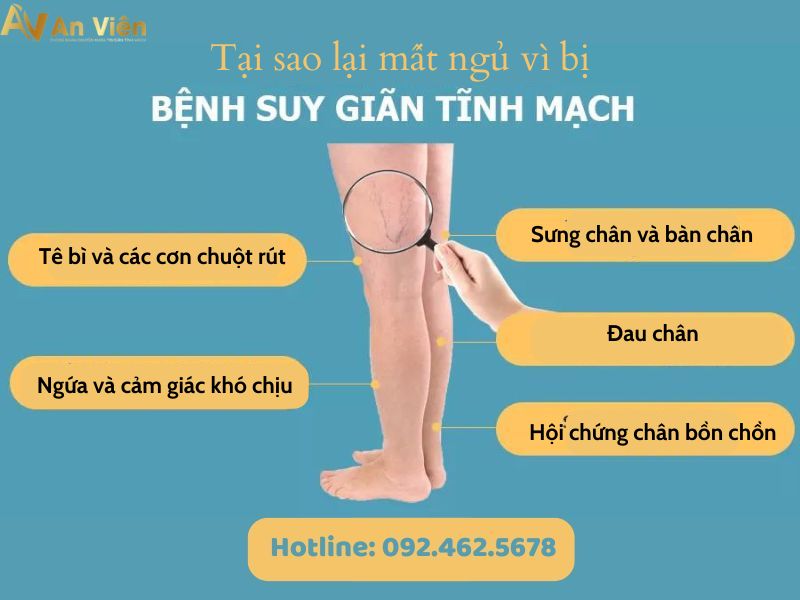giãn tĩnh mạch ở chân