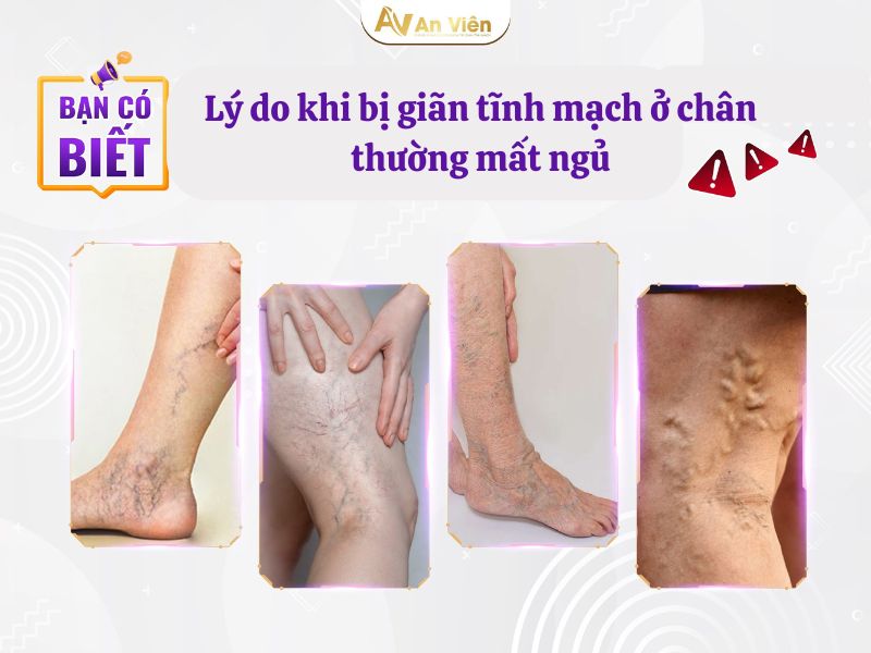 giãn tĩnh mạch ở chân