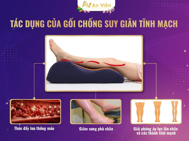 giãn tĩnh mạch ở chân