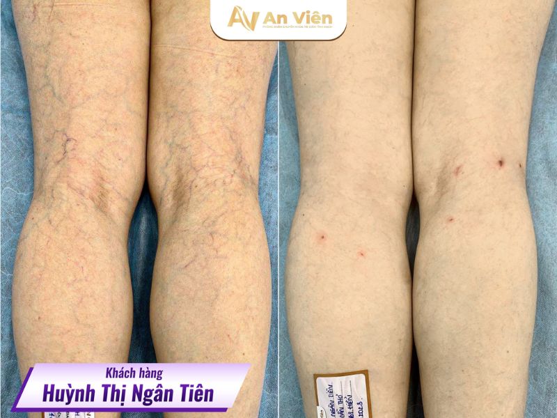 hiện tượng giãn tĩnh mạch chân