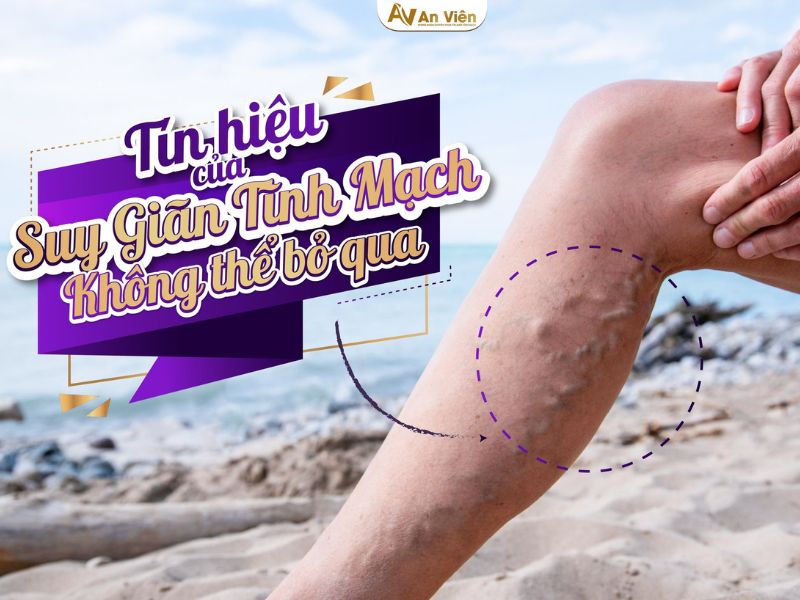 hiện tượng giãn tĩnh mạch chân