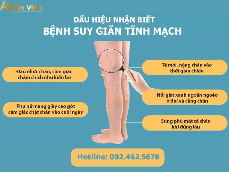 hiện tượng giãn tĩnh mạch chân