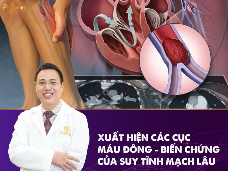 suy tĩnh mạch chân