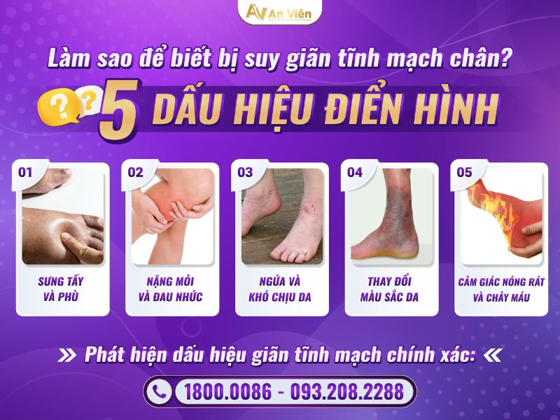 suy van tĩnh mạch chi dưới