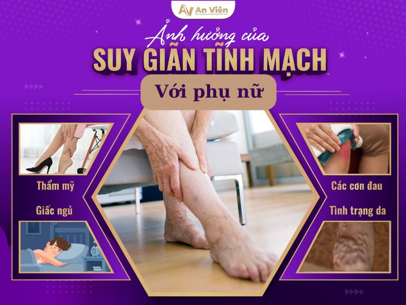 suy van tĩnh mạch chi dưới