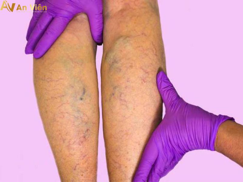 suy van tĩnh mạch sâu chi dưới
