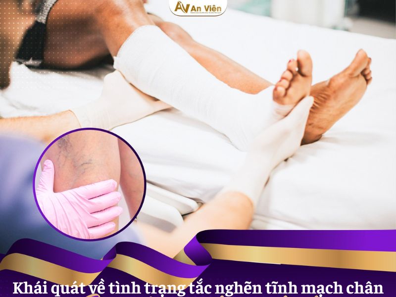 tắc nghẽn tĩnh mạch chân