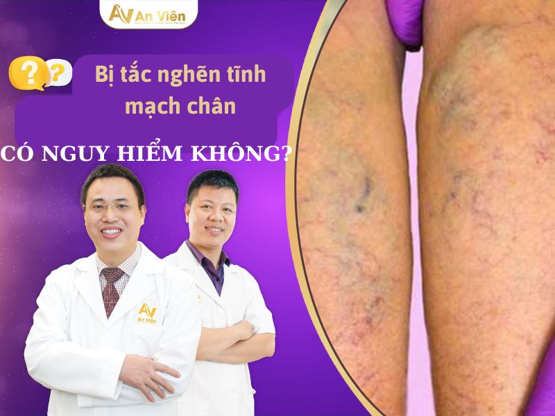 tắc nghẽn tĩnh mạch chân