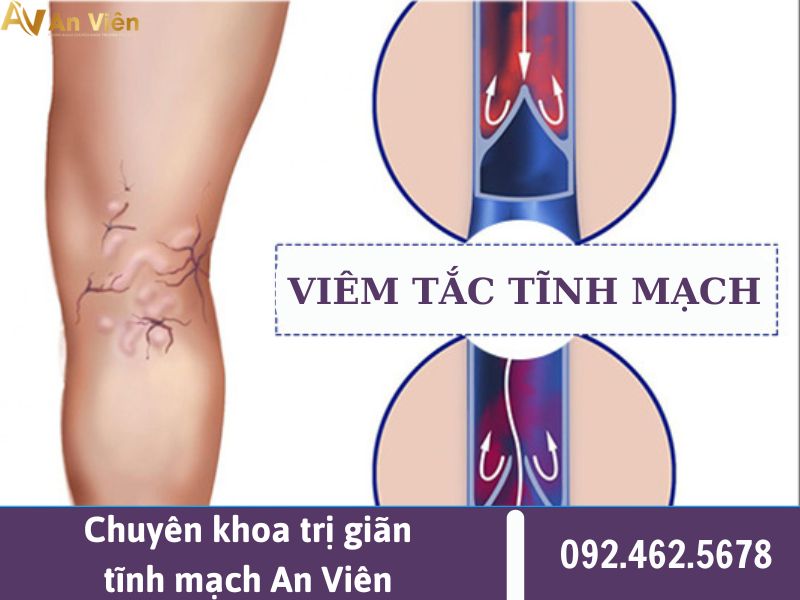 tắc tĩnh mạch chi dưới