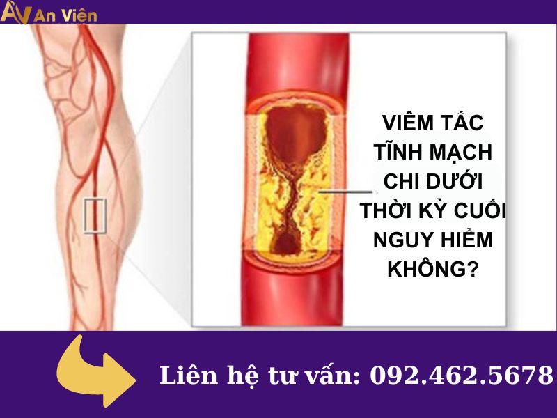 tắc tĩnh mạch chi dưới