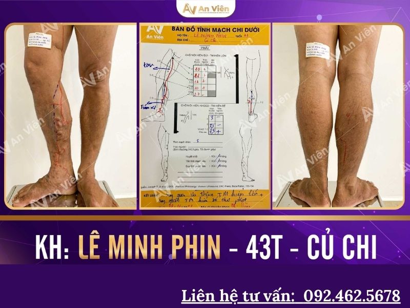 bị giãn tĩnh mạch