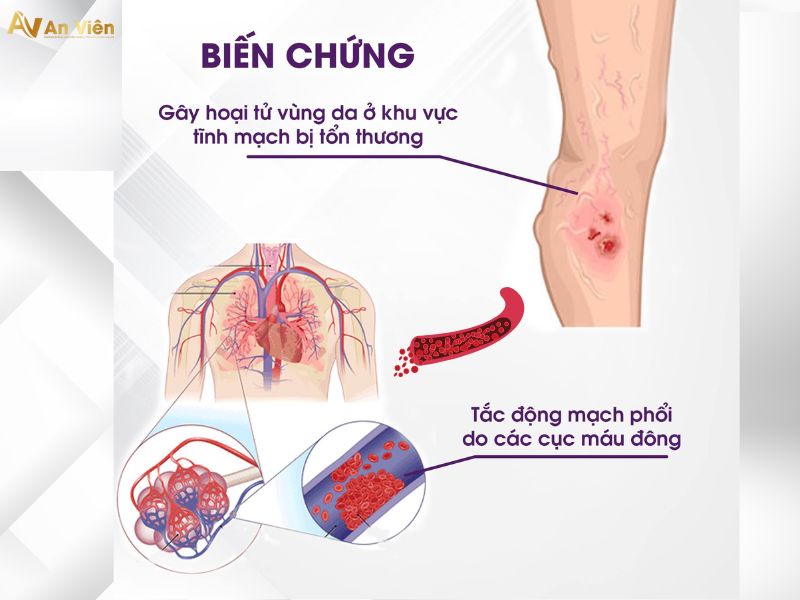 bị giãn tĩnh mạch
