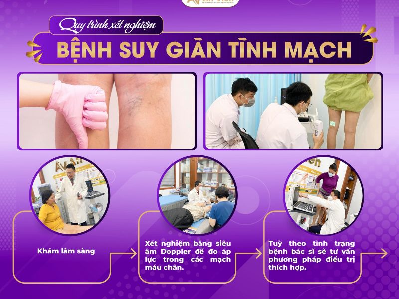 bị giãn tĩnh mạch