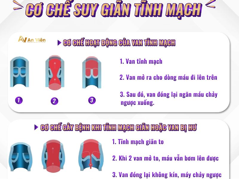 bị giãn tĩnh mạch có đi bộ được không