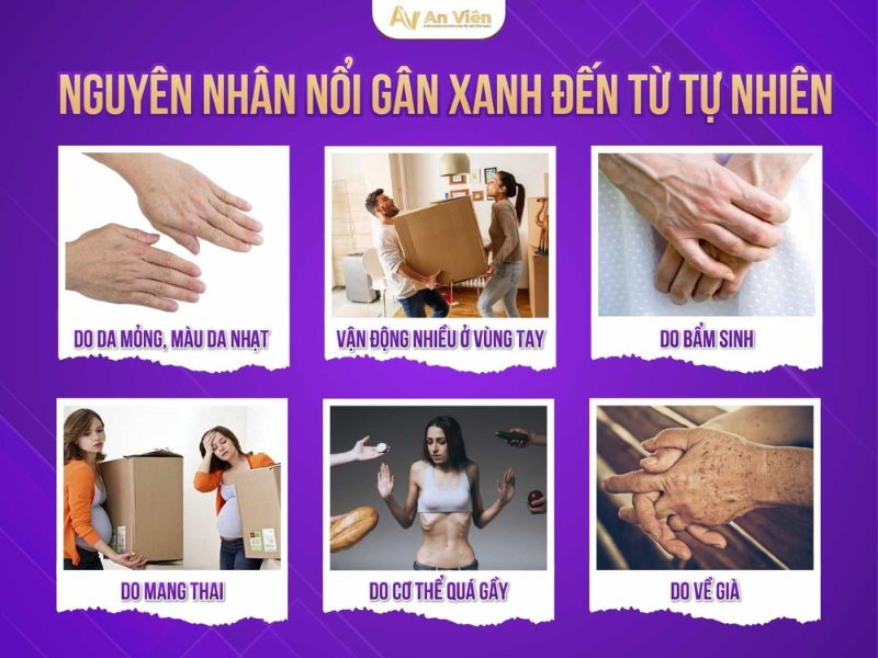 bị nổi gân xanh ở tay
