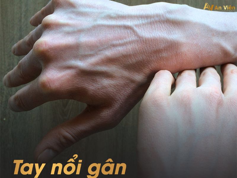 bị nổi gân xanh ở tay