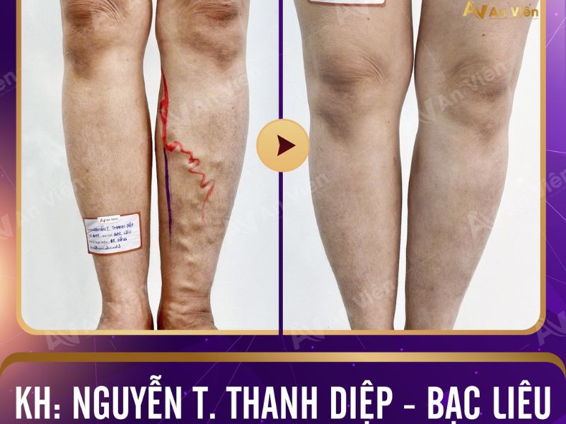 bị tĩnh mạch