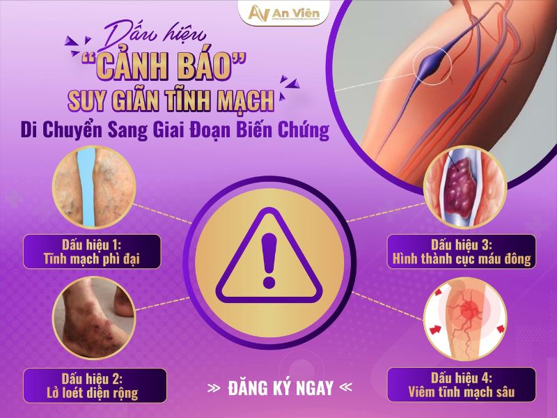 bị tĩnh mạch