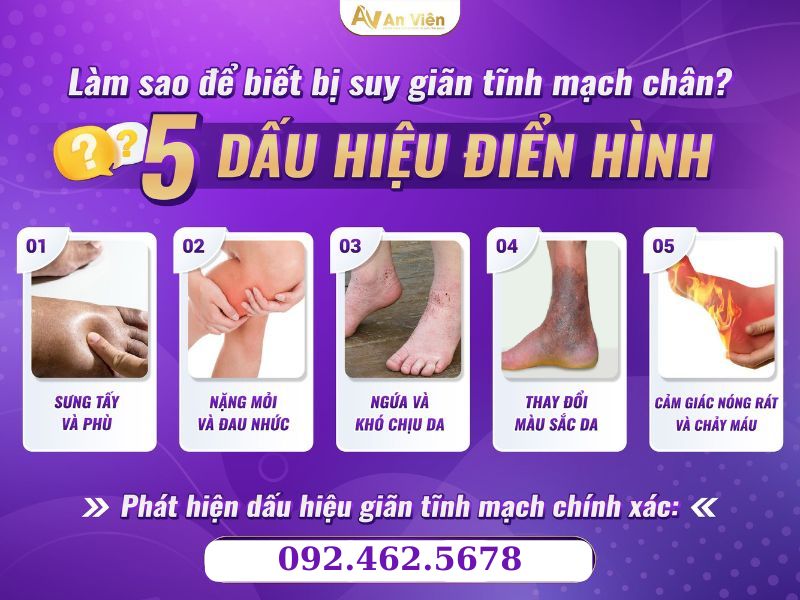 bị tĩnh mạch