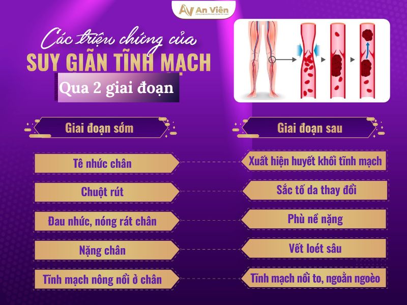 bị tĩnh mạch