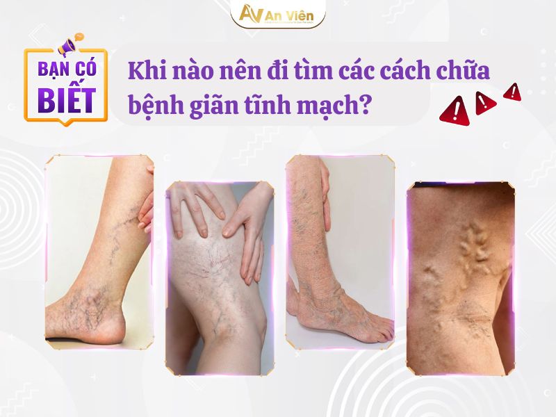 cách chữa bệnh giãn tĩnh mạch