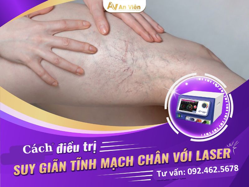 cách chữa bệnh giãn tĩnh mạch
