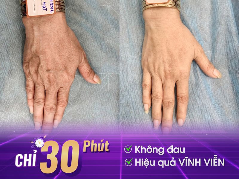 cách chữa bệnh giãn tĩnh mạch