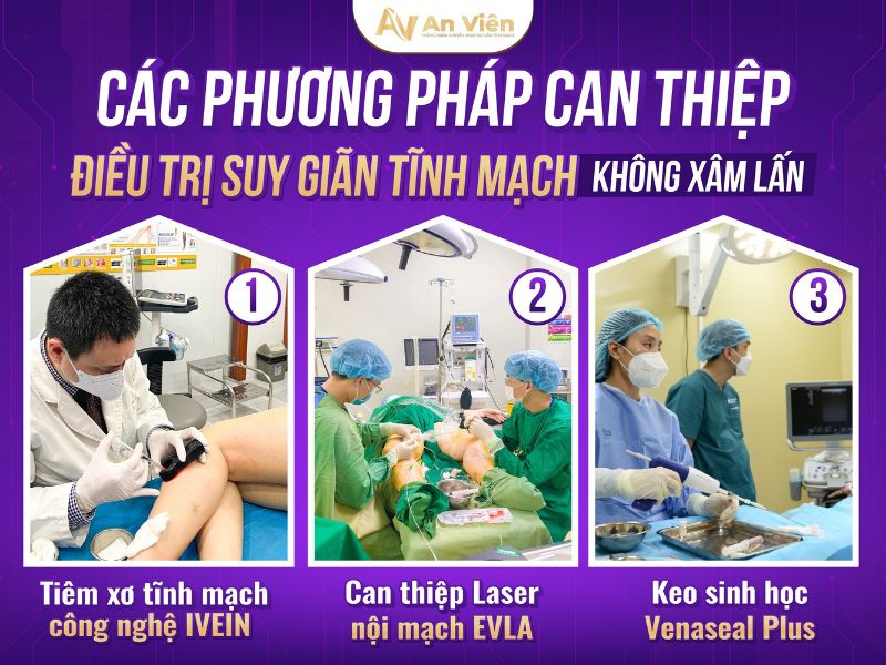 cách giảm suy giãn tĩnh mạch