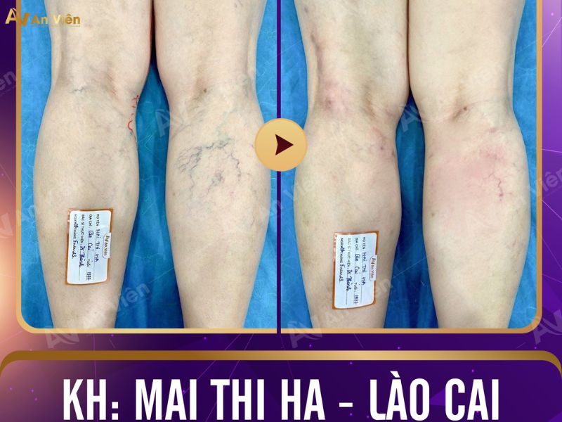 chữa suy giãn tĩnh mạch