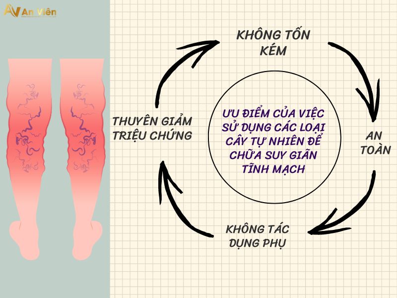 chữa suy giãn tĩnh mạch