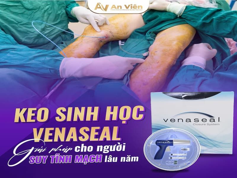 điều trị suy giãn tĩnh mạch chân