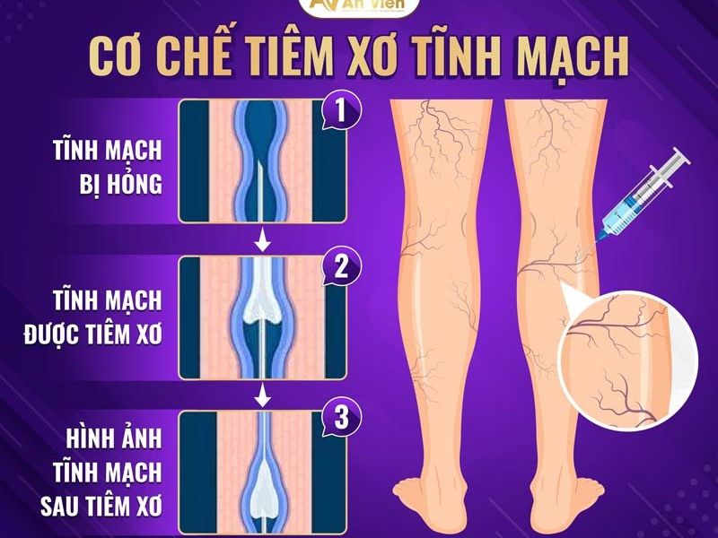 điều trị suy giãn tĩnh mạch chân