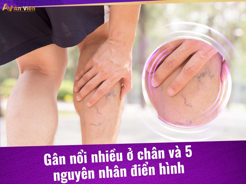 gân nổi nhiều ở chân