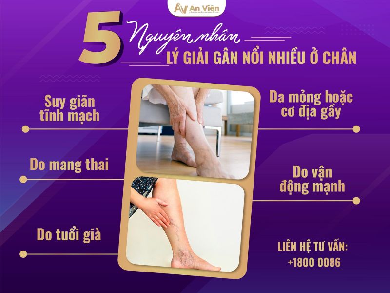 gân nổi nhiều ở chân